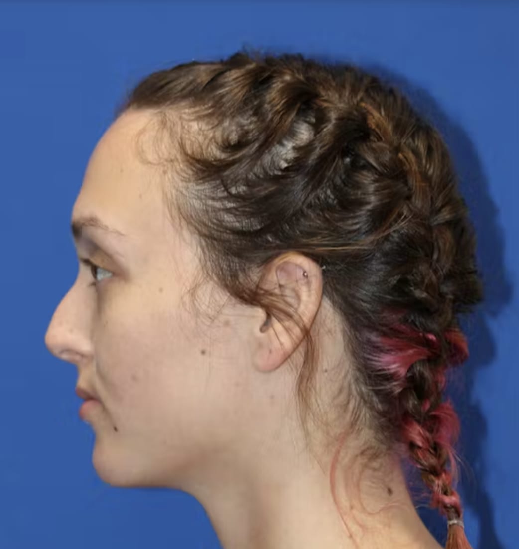 Rhinoplasty Before, Female 25 - 4830