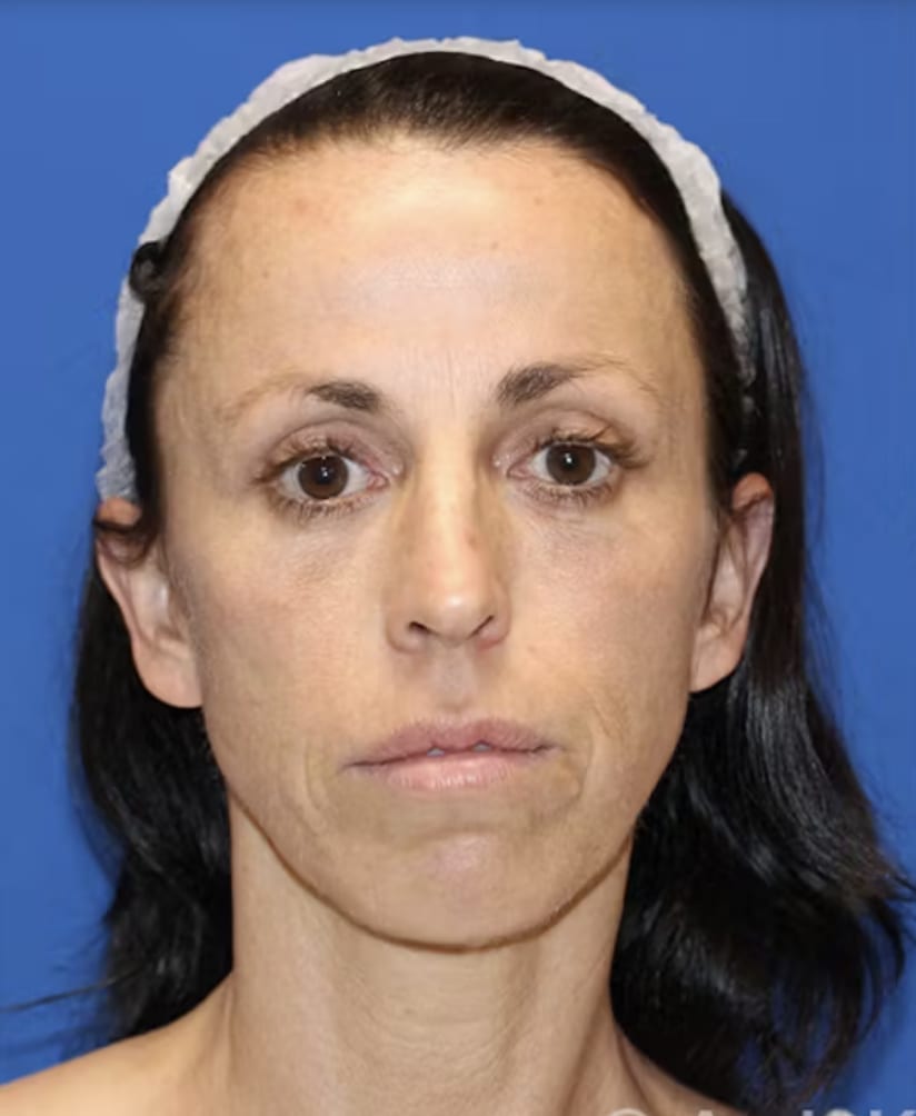 Rhinoplasty Before, Female 44 - 4831