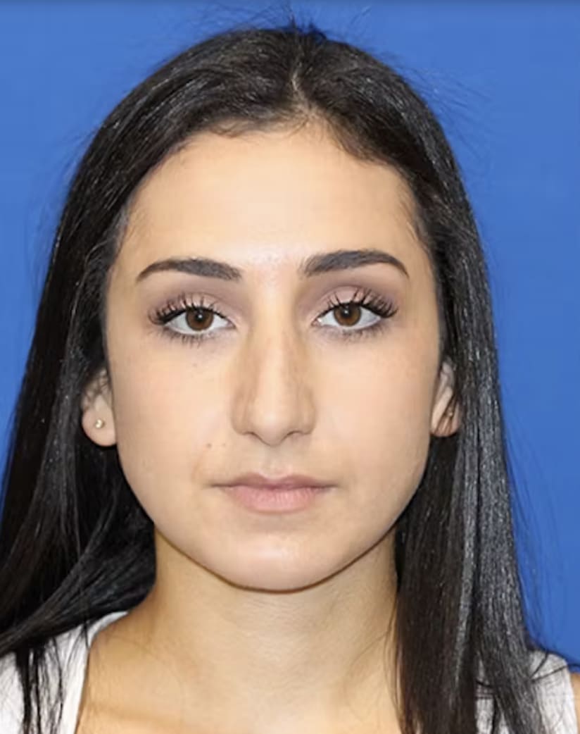 Rhinoplasty Before, Female 26 - 4832