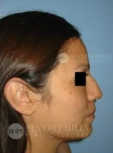 Rhinoplasty Before, Female 35 - 4806