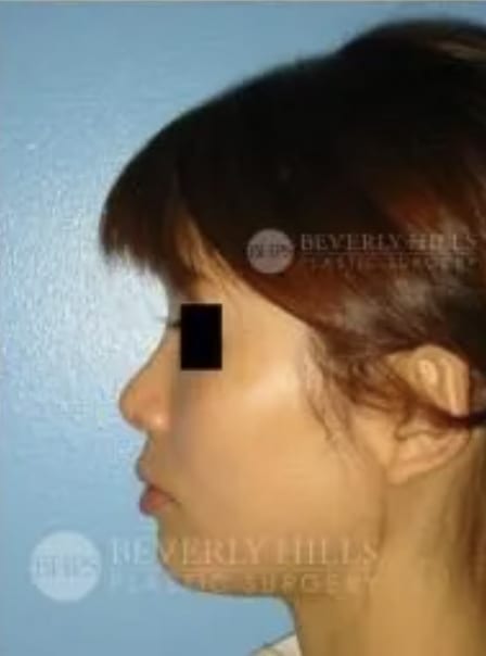 Rhinoplasty After, Female 41 - 4808