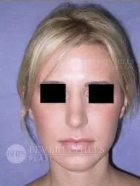 Rhinoplasty After, Female 31 - 4799