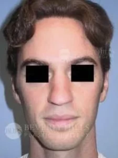 Rhinoplasty Before, Male 28 - 4800