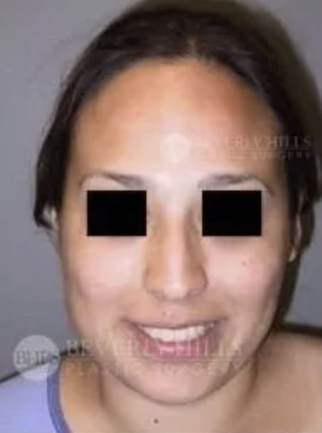 Rhinoplasty Before, Female 34 - 4802