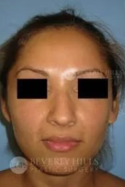 Rhinoplasty Before, Female 38 - 4803
