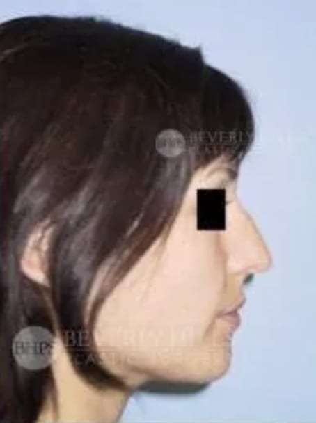 Rhinoplasty Before, Female 29 - 4804