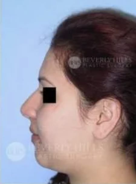Rhinoplasty Before, Female 32 - 4805