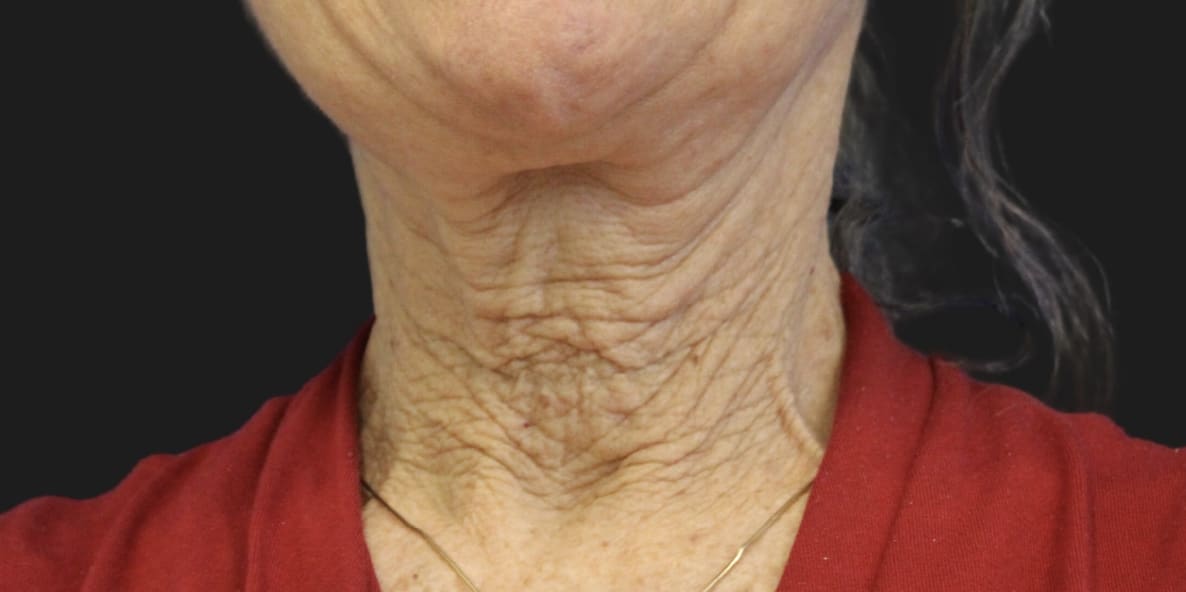 Neck Lift Before, Female 65 - 4728