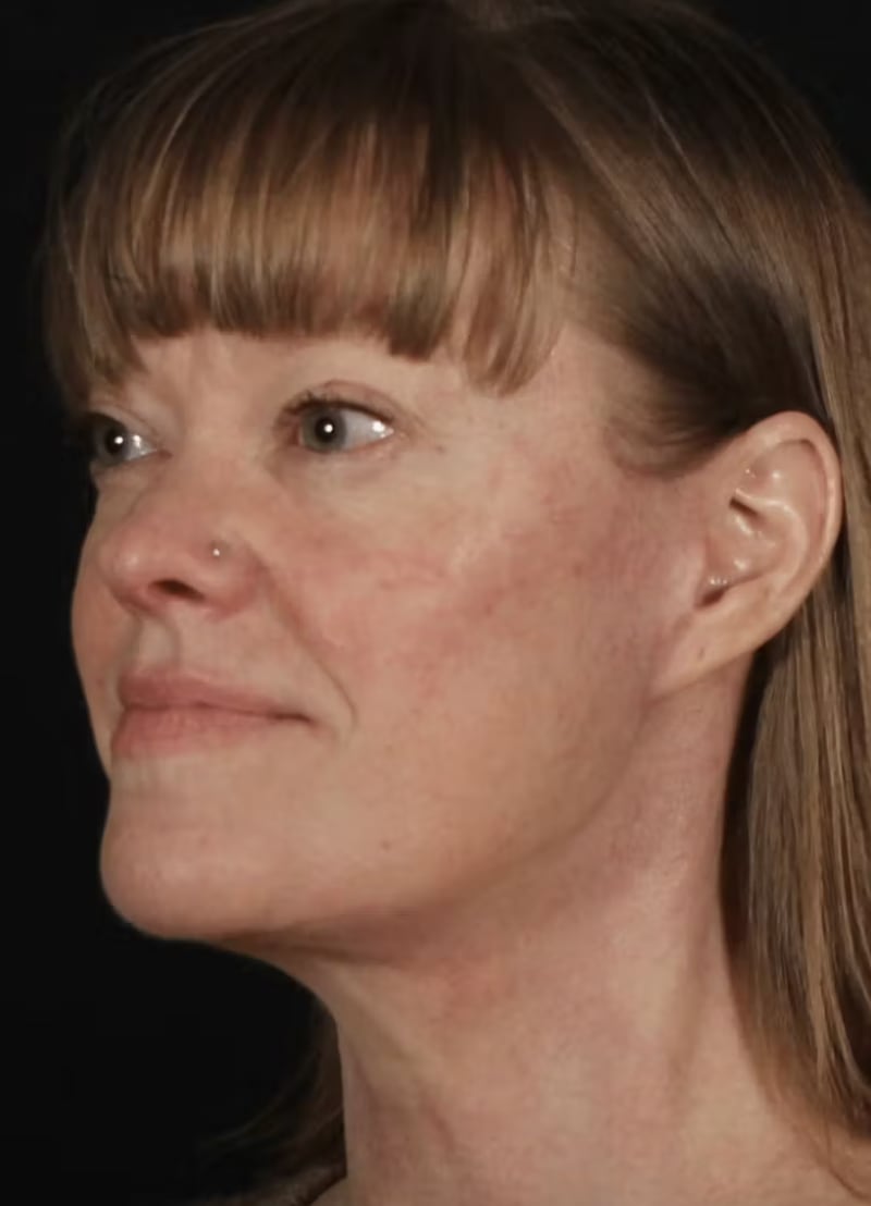 Neck Lift After, Female 44 - 4795