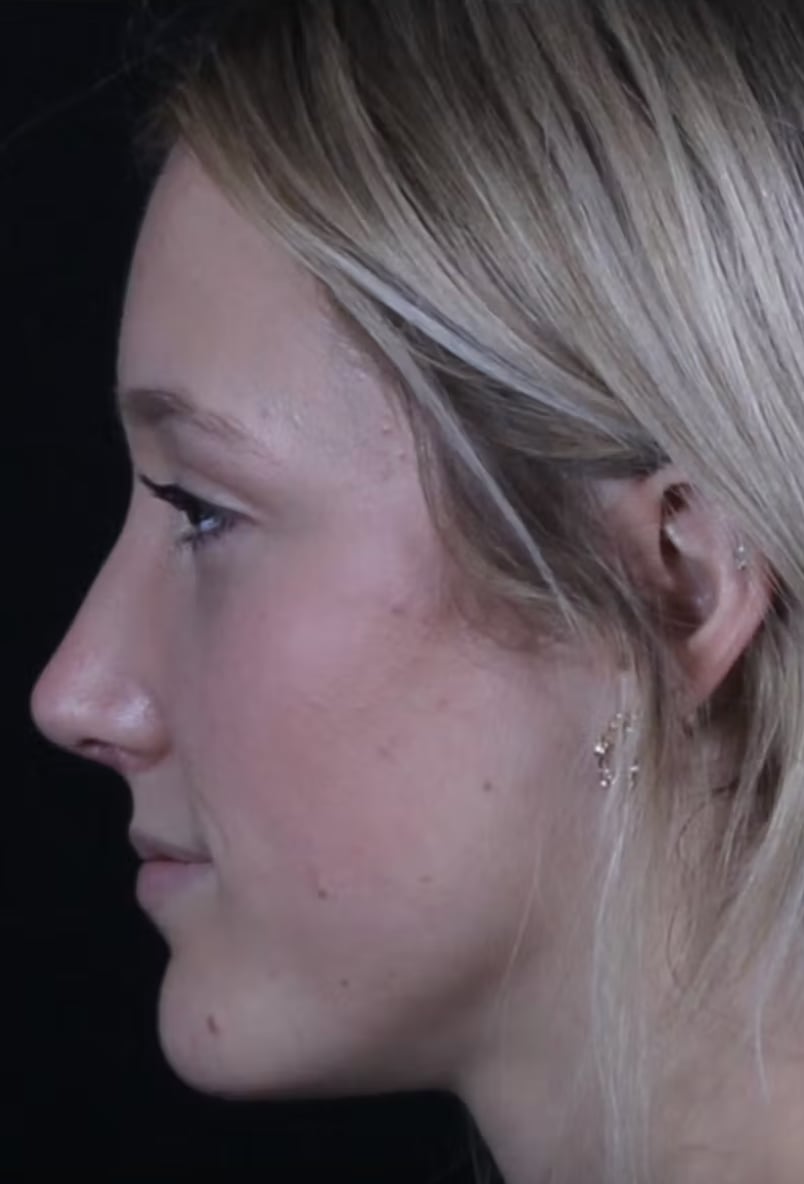 Rhinoplasty After, Female 25 - 4773