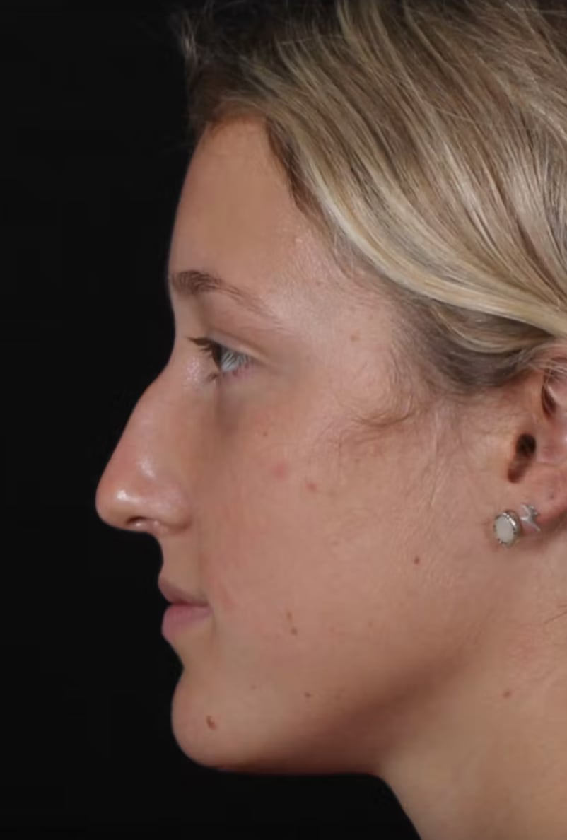 Rhinoplasty Before, Female 25 - 4773