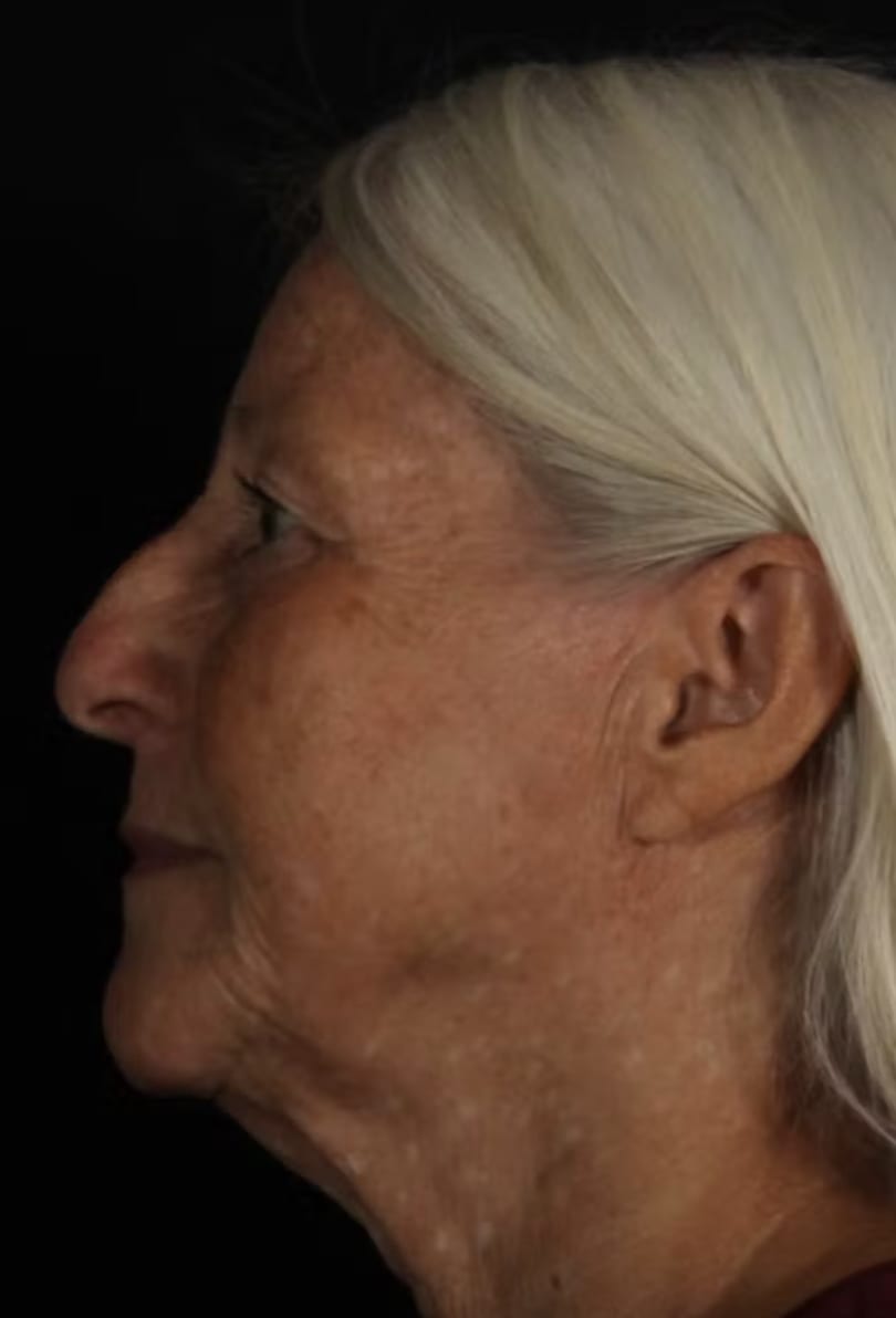 Rhinoplasty Before, Female 74 - 4774