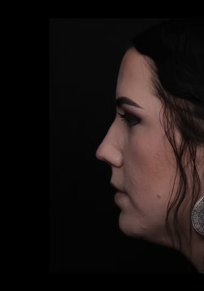 Rhinoplasty Before, Female 32 - 4779