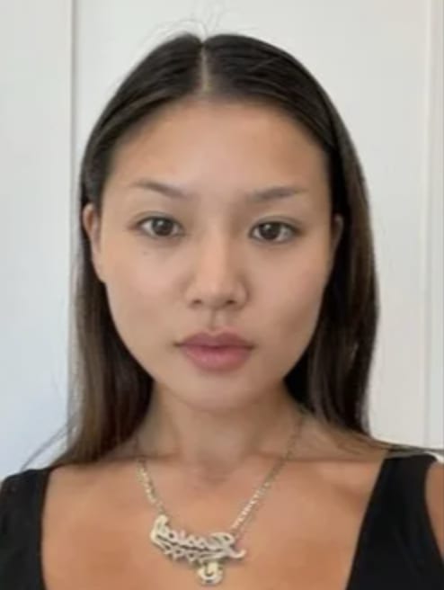 Buccal Fat Removal After, Female 28 - 4735