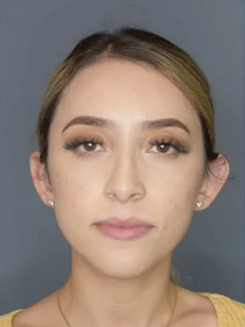 Otoplasty Before, Female 26 - 4742