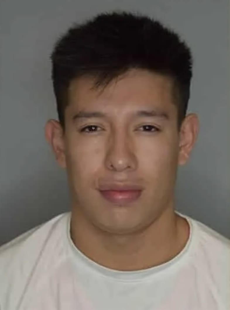 Otoplasty Before, Male 28 - 4743