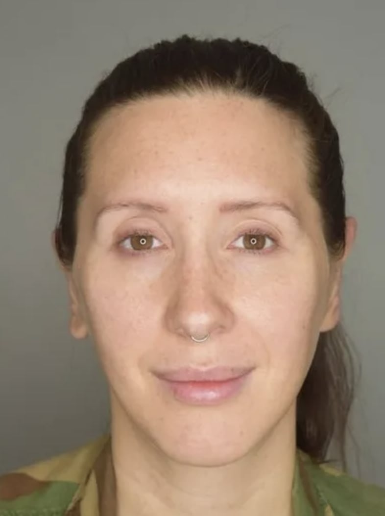 Otoplasty After, Female 34 - 4745