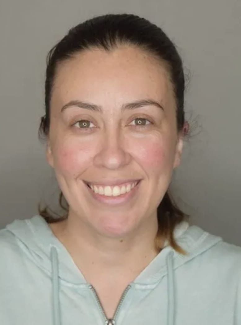 Otoplasty After, Female 35 - 4746