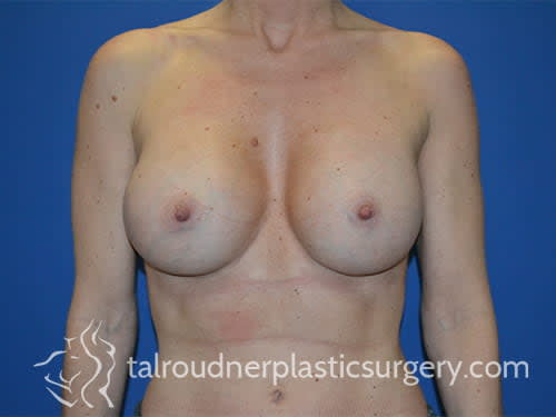 Breast Augmentation with Implants After, Female 44 - 4763