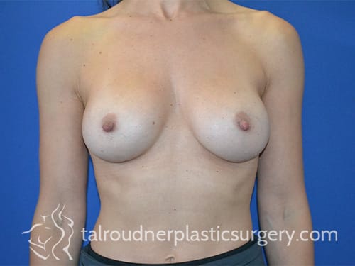 Breast Augmentation with Implants After, Female 40 - 4764