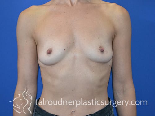 Breast Augmentation with Implants Before, Female 40 - 4764