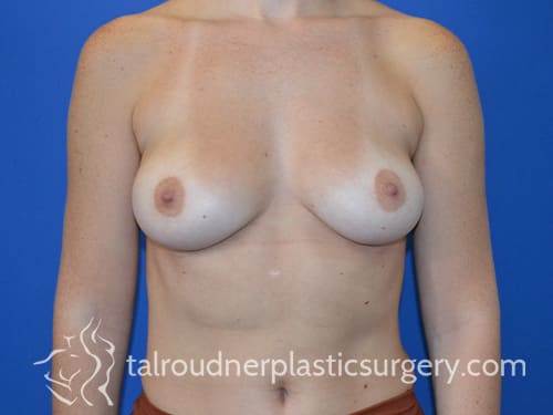Breast Augmentation with Implants Before, Female 30 - 4765