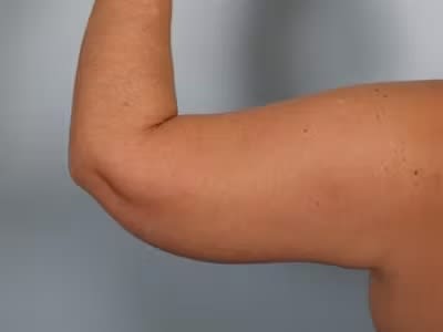 Arm Lift After, Female 42 - 4690