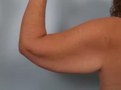 Arm Lift Before, Female 42 - 4690