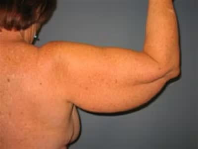 Arm Lift Before, Female 55 - 4693