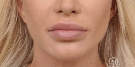 Lip Lift After, Female 34 - 4668