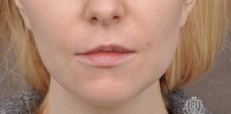 Lip Lift Before, Female 31 - 4670