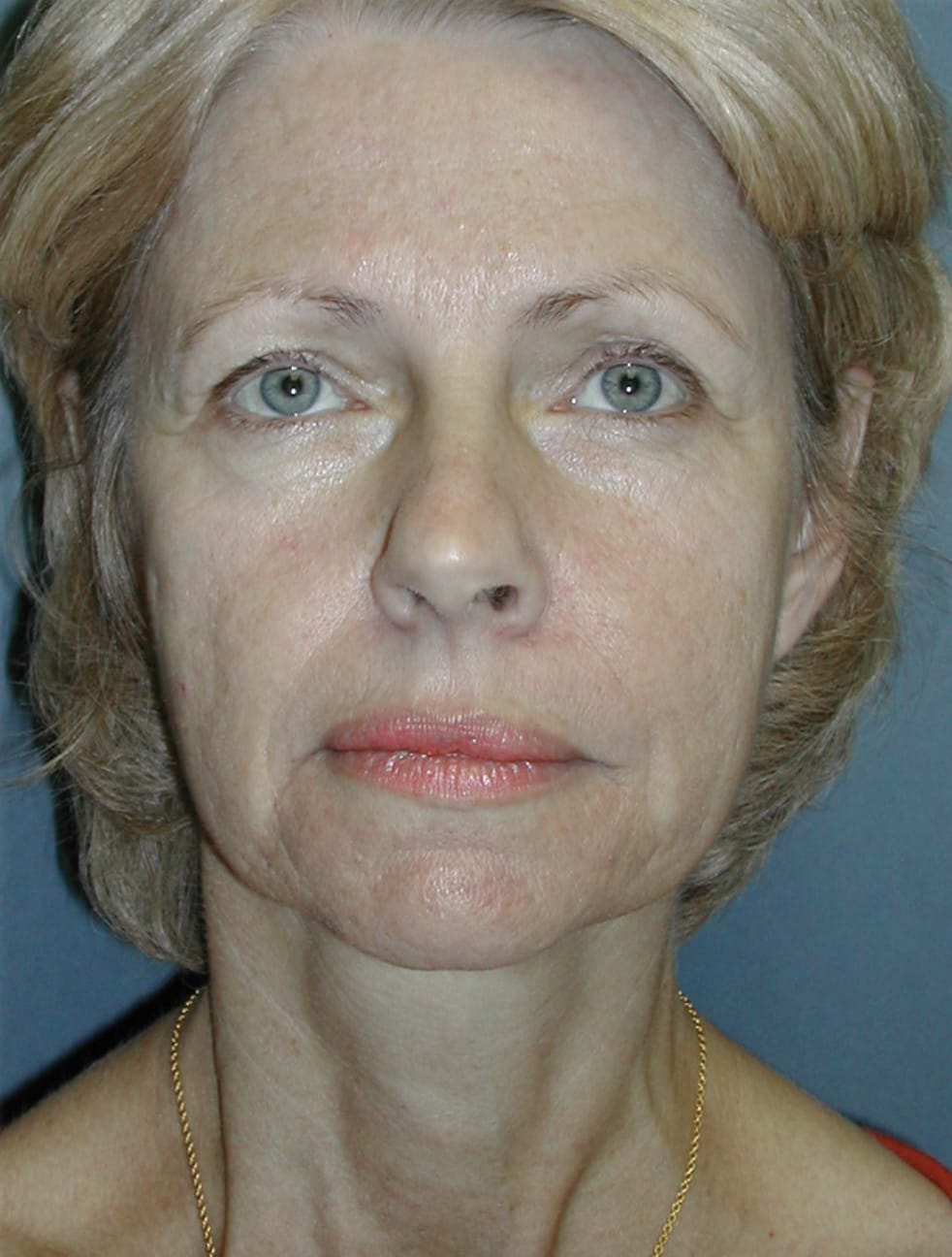 Brow Lift Before, Female 47 - 4634