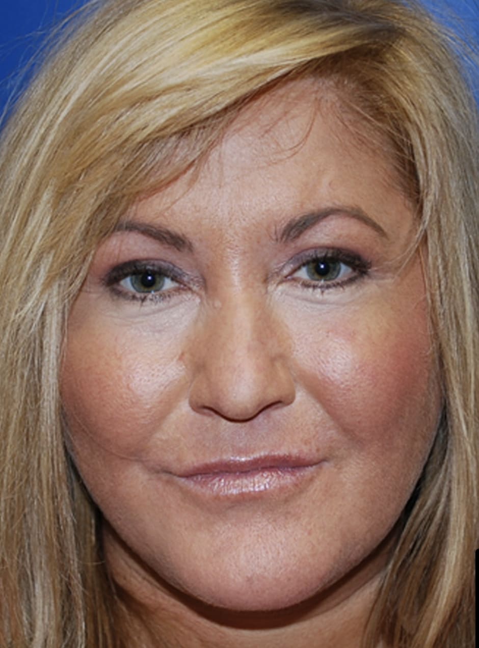 Facelift After, Female 44 - 4627