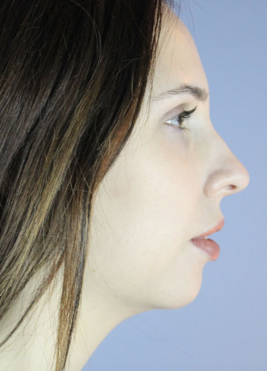 Neck Lift Before, Female 26 - 4629