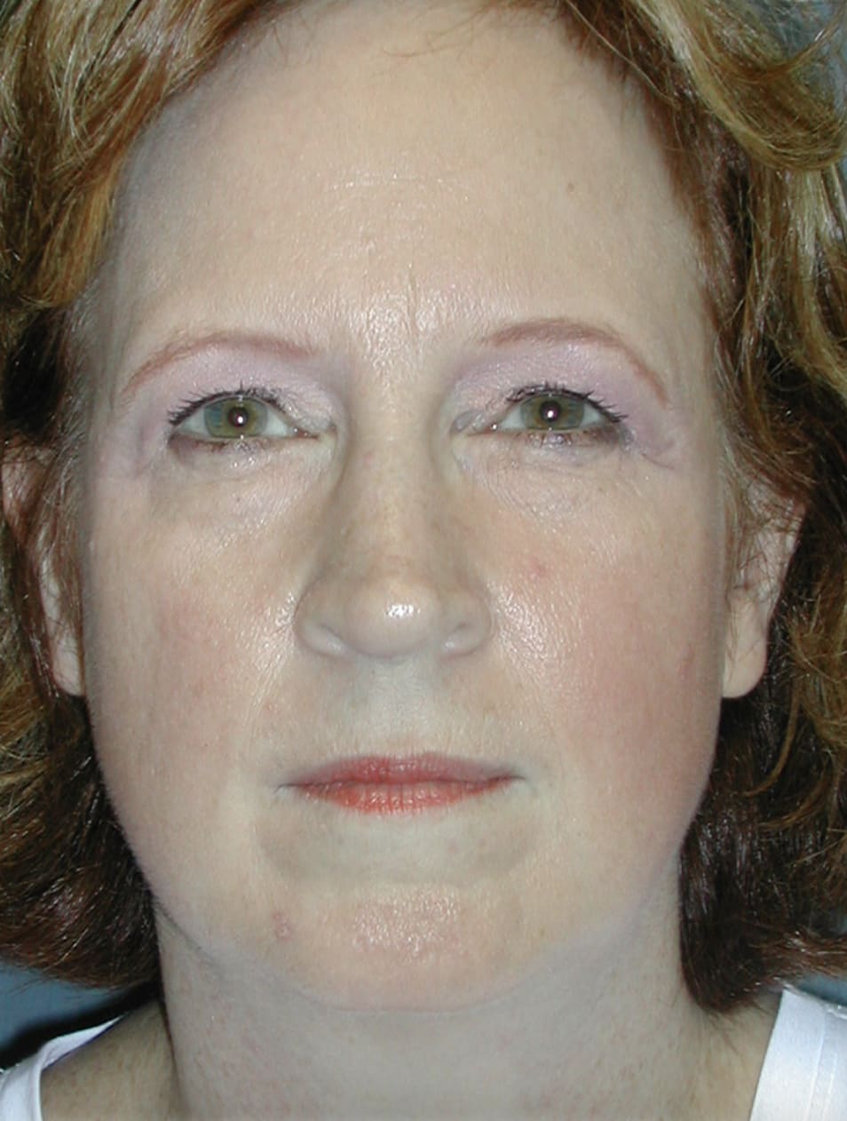 Brow Lift Before, Female 47 - 4636