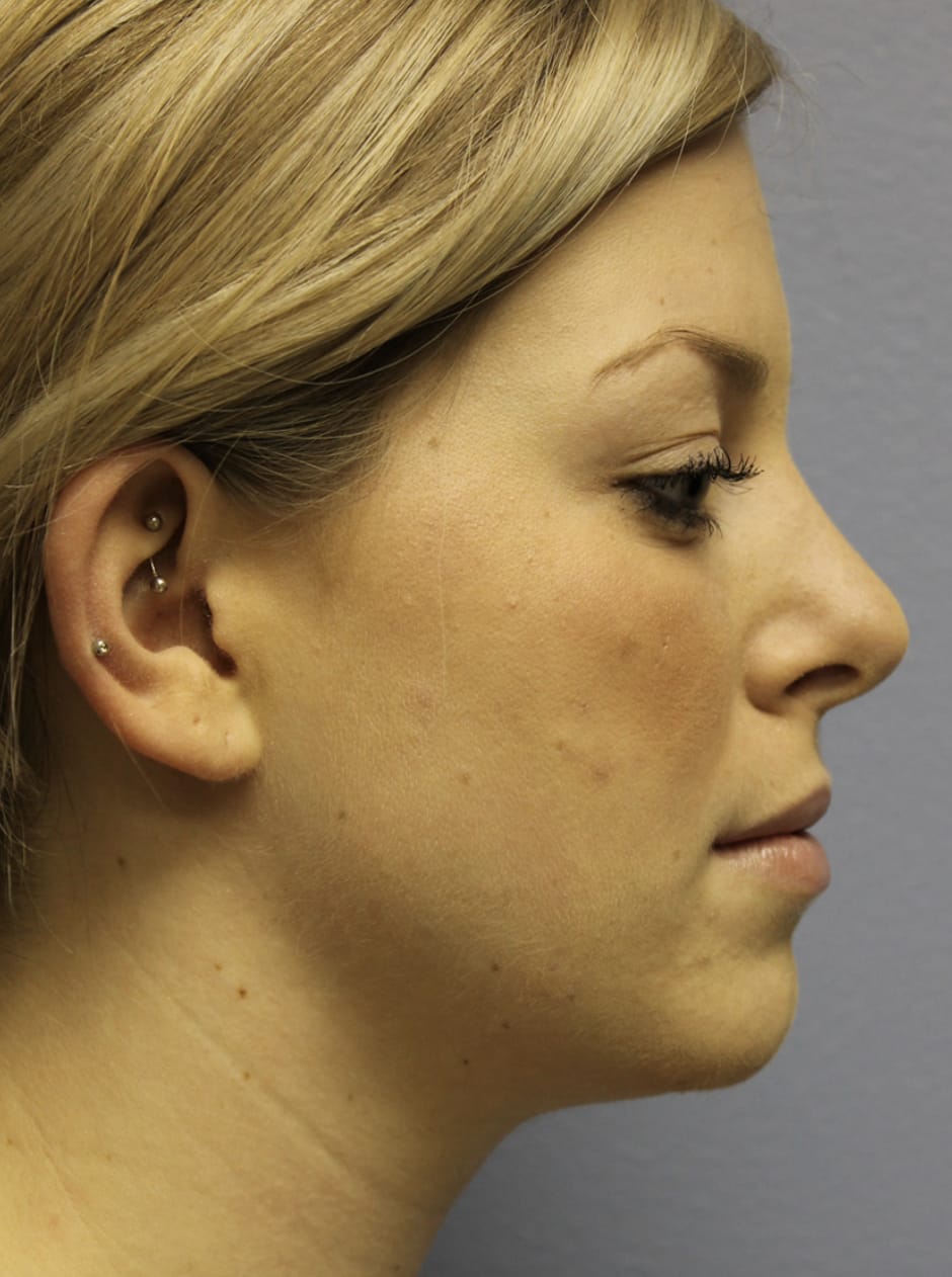 Neck Lift Before, Female 25 - 4630