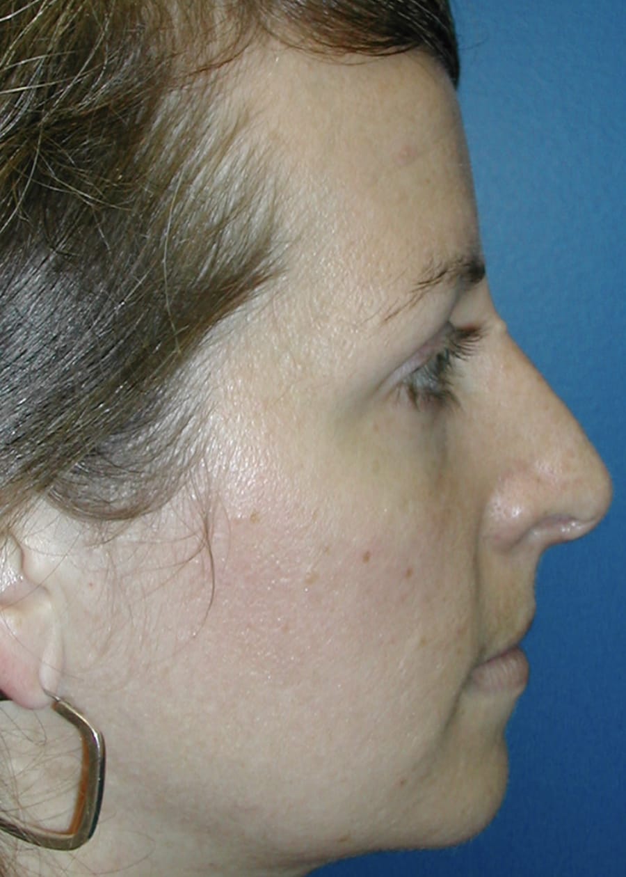 Rhinoplasty After, Female 34 - 4626