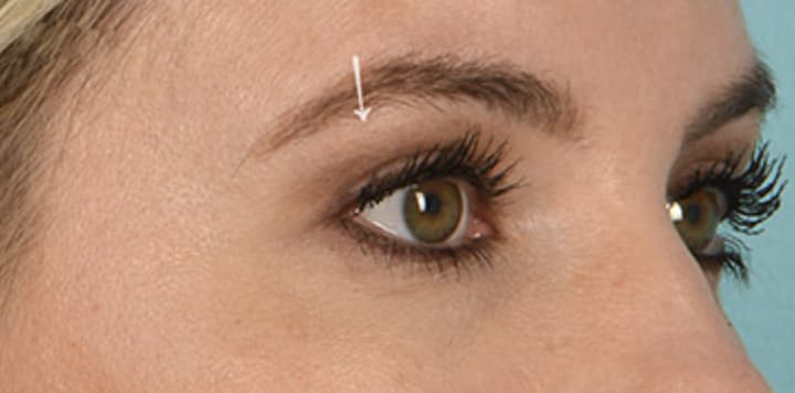 Upper Eyelid Blepharoplasty After, Female 31 - 4841