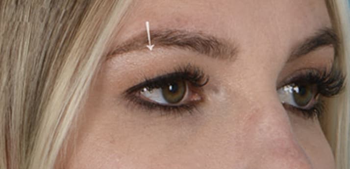 Upper Eyelid Blepharoplasty Before, Female 31 - 4841