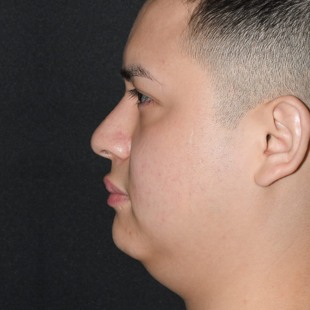 Chin Augmentation Before, Male 23 - 52