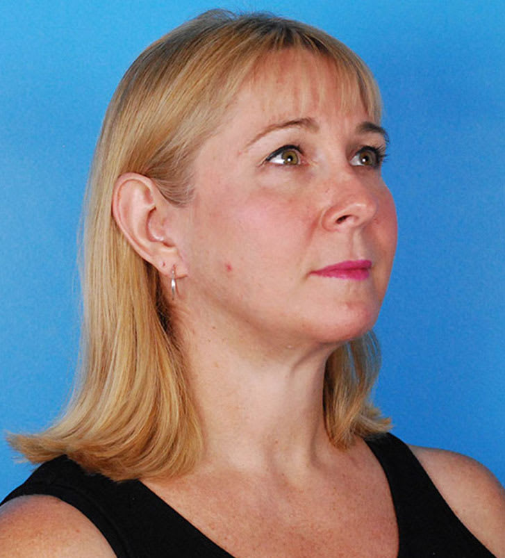 Cheek Augmentation (Cheek Implants) After, Female 57 - 2354
