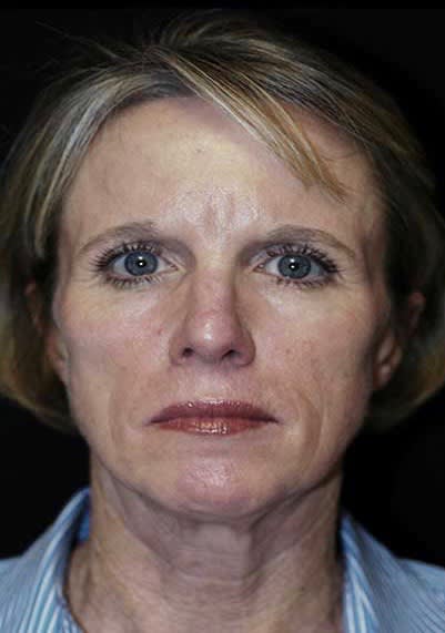 Facelift Before, Female 61 - 2018