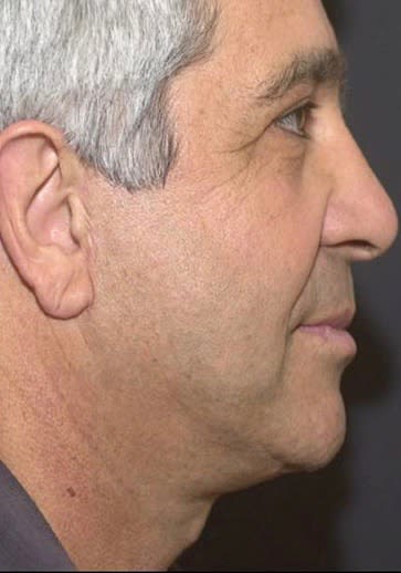 Facelift After, Male 63 - 2021