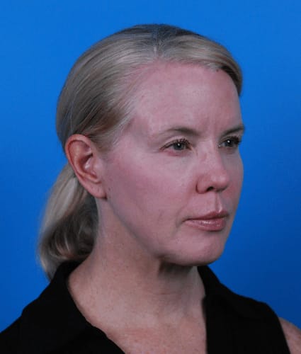 Brow Lift Before, Female 53 - 2353