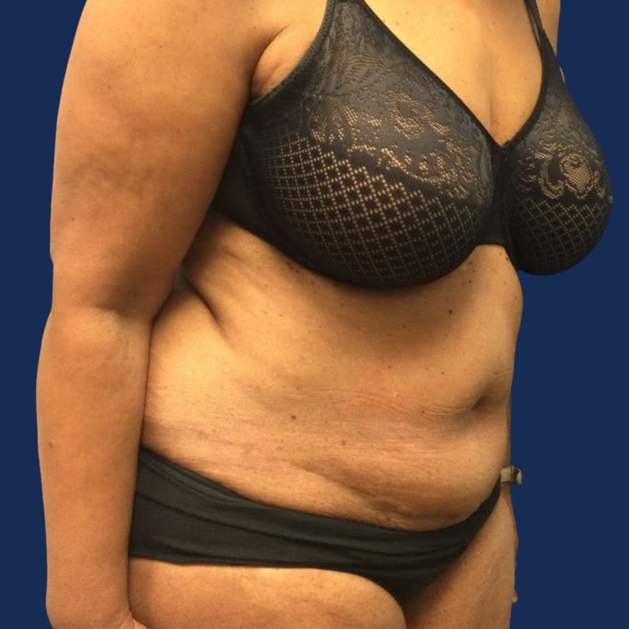 Tummy Tuck (Abdominoplasty) After, Female 68 - 3596