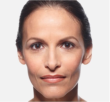 Dermal Fillers & Injectables After, Female 35 - 4857