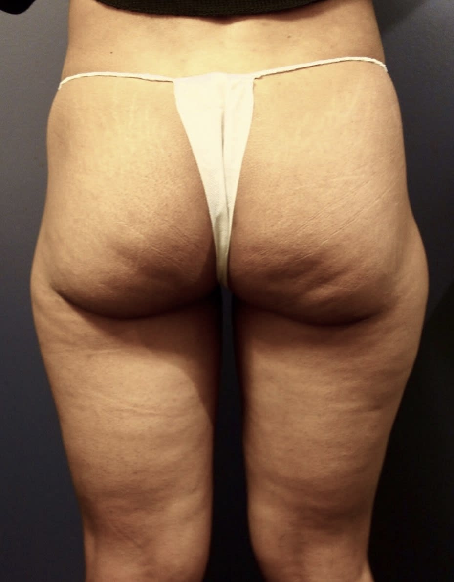 Liposuction Before, Female 47 - 107