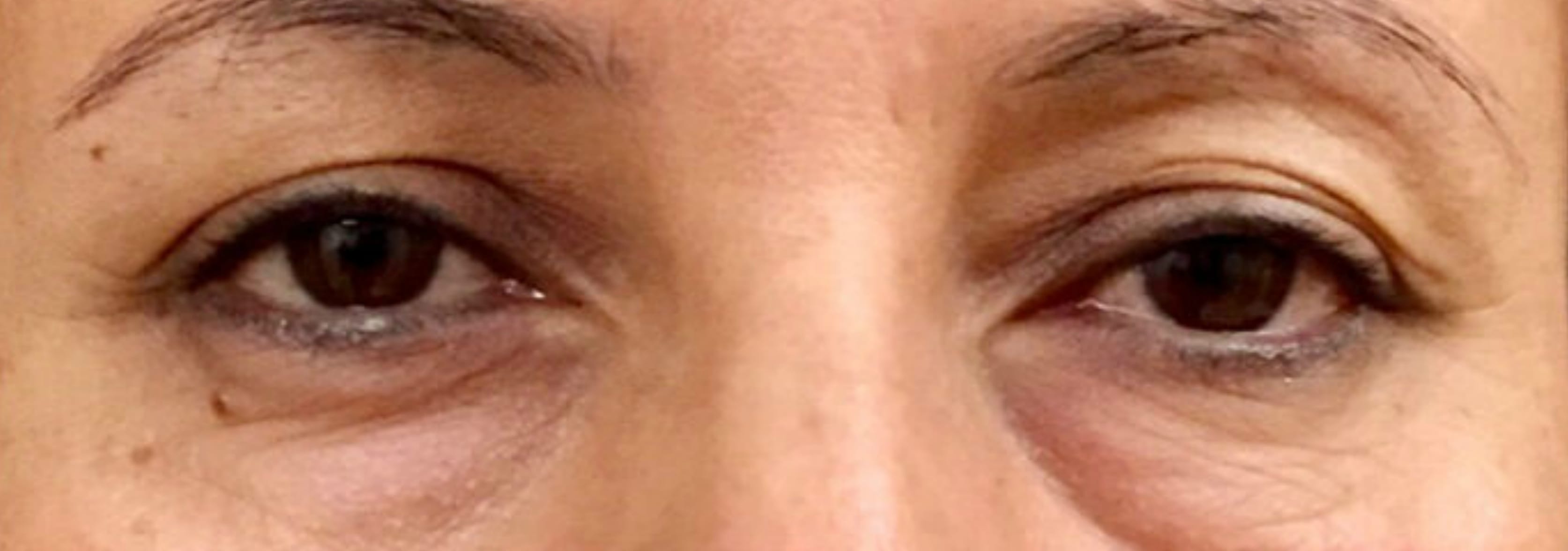 Blepharoplasty Before, Female 40 - 113