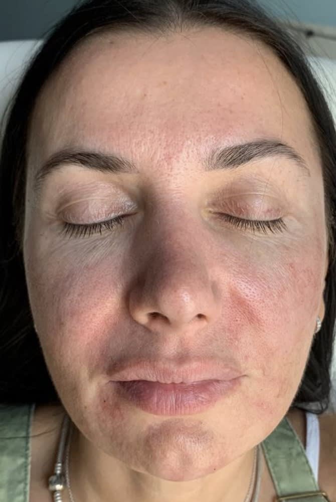 Dermal Filler & Injectable Solutions After, Female 45 - 4136