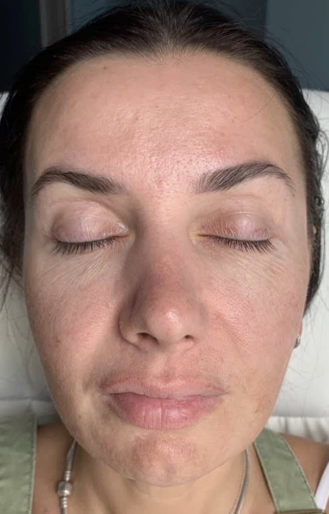 Dermal Filler & Injectable Solutions Before, Female 45 - 4136